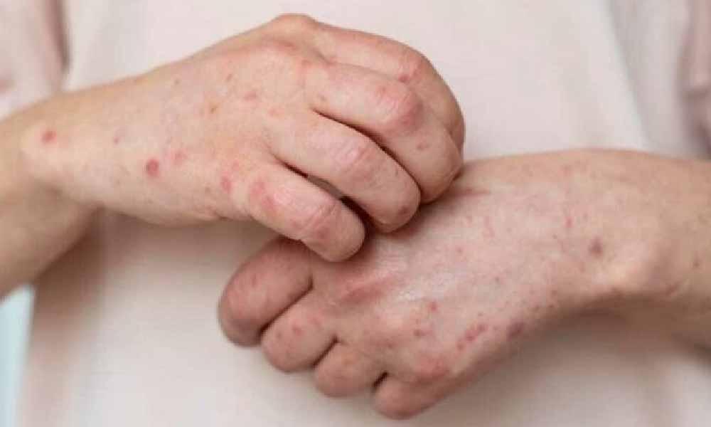 Alerta en Paraguay por casos de sarampión en la región
